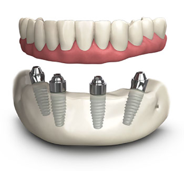 Trồng răng implant toàn hàm All on 4