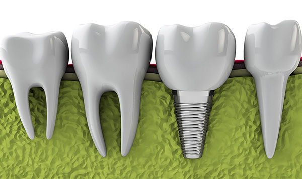 Phương pháp trồng răng Implant vài răng là gì?