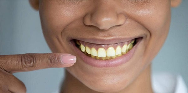 Nguyên nhân dẫn đến hiện tượng răng ố vàng
