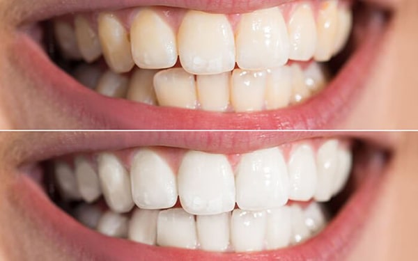 Tẩy trắng răng tại nhà có hiệu quả không?