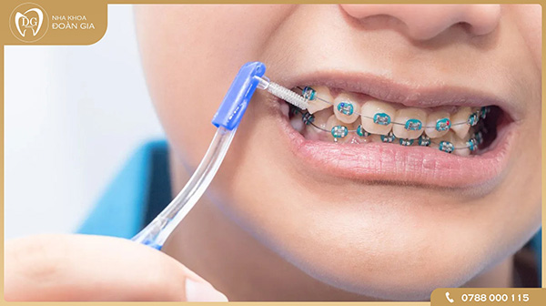 Tầm quan trọng của việc biết cách vệ sinh răng niềng khi thực hiện chỉnh nha