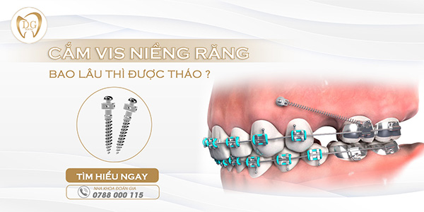 Cắm vít niềng răng bao lâu thì tháo?