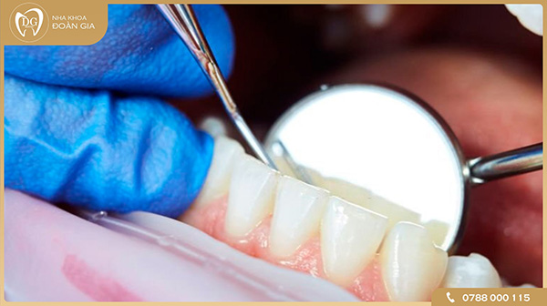 Quy trình cạo vôi răng được thực hiện như thế nào?