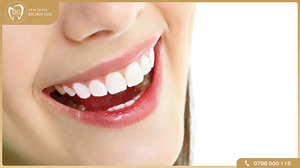 Lợi ích của việc lấy cao răng thường xuyên