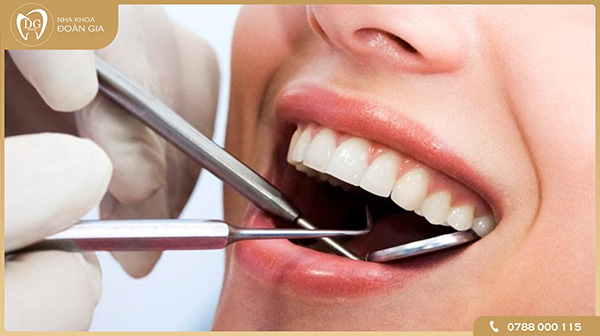Tẩy trắng răng là gì?