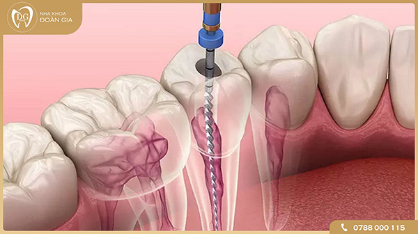 Quy trình điều trị tủy răng tại Nha khoa Đoàn Gia