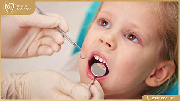 Các phương pháp chữa tủy răng cho bé