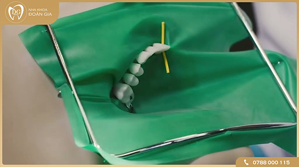 Quy trình chữa tủy răng là gì?