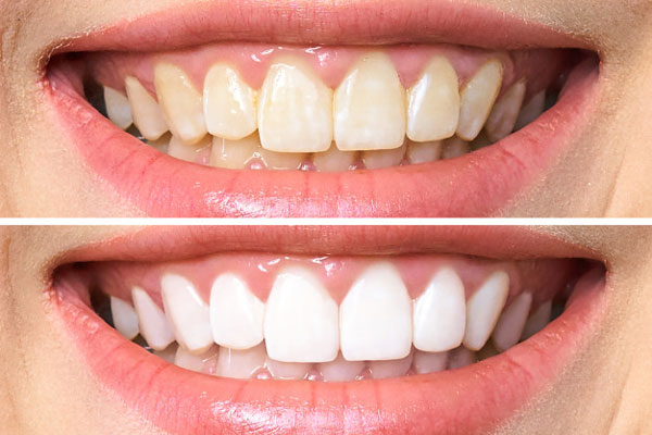 Tẩy trắng răng có tác dụng bao lâu