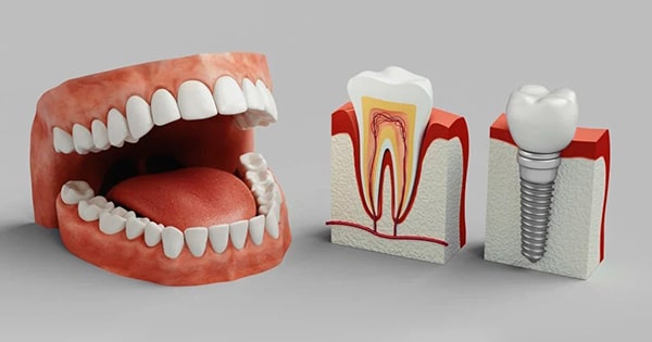 Ưu điểm của cấy ghép răng implant