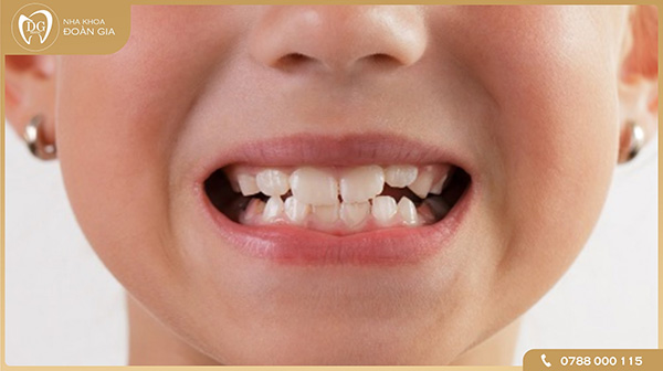 Hạn chế tối đa các bệnh về răng miệng