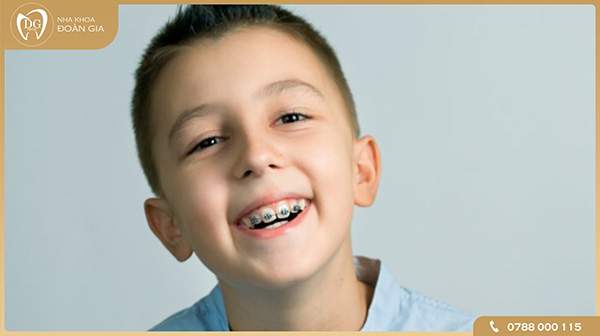 Phương pháp niềng răng cho trẻ em hiệu quả