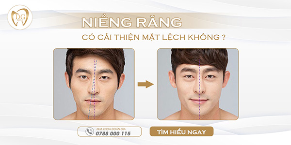 Niềng răng có cải thiện mặt lệch không?