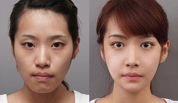 Khuôn mặt trước và sau khi niềng răng móm (khớp cắn ngược)