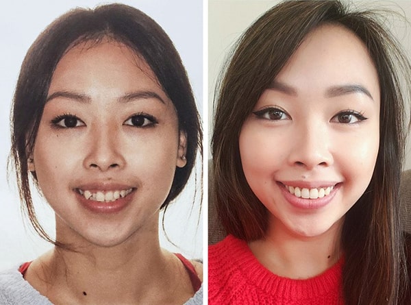 Khuôn mặt trước và sau khi niềng răng lệch lạc