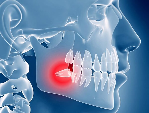 Niềng răng phải nhổ bao nhiêu răng?