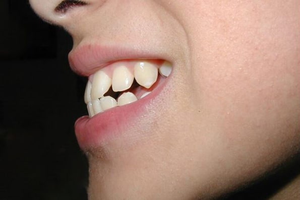 Bị hô hàm trên có niềng răng được không?