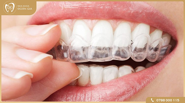 Phương pháp niềng răng không mắc cài là gì?