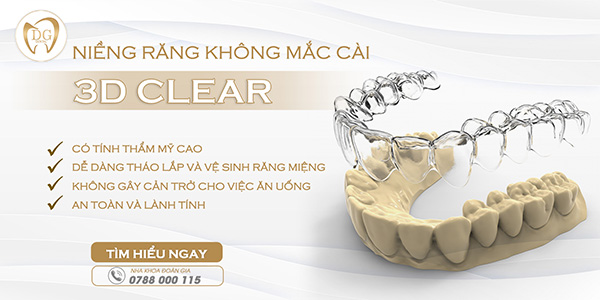 Niềng răng không mắc cài 3D Clear có ưu nhược điểm gì?