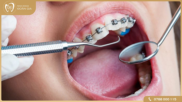 Vấn đề phát sinh trong quá trình niềng răng