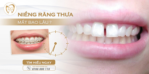 Niềng răng thưa mất bao lâu? Có những phương pháp niềng răng thưa nào?