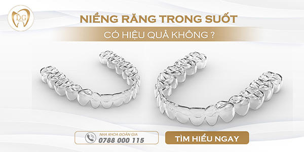 Niềng răng trong suốt có hiệu quả không?