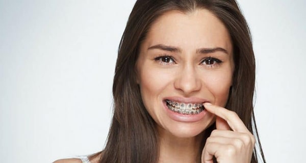 Tại sao niềng răng xong vẫn xấu?