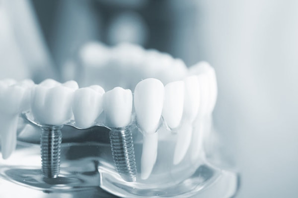 Phương pháp trồng răng Implant là gì?