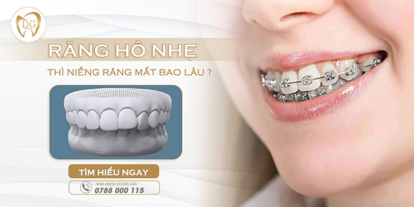 Răng hô nhẹ niềng mất bao lâu?