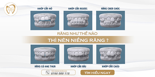 Niềng răng là gì? Răng như thế nào thì nên niềng?