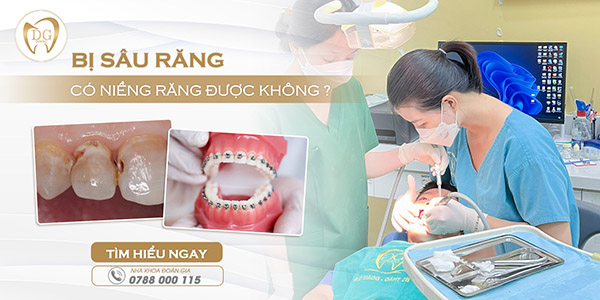 Răng sâu có niềng được không?