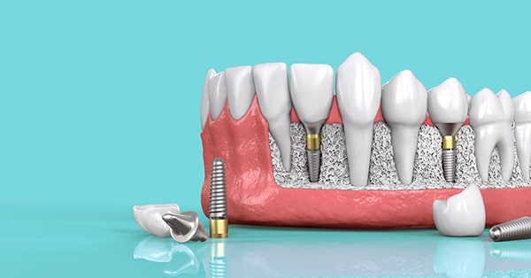 Khi nào cần trồng răng Implant?