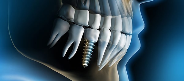 Tại sao cần trồng răng Implant sau mất răng?
