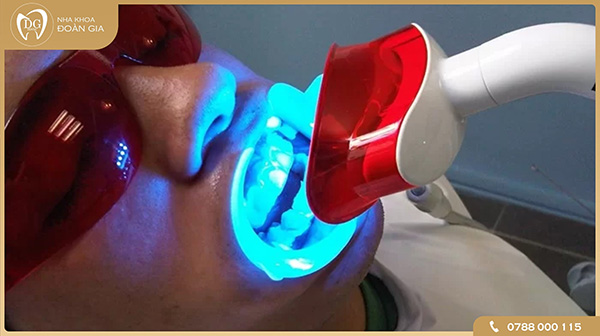 Tẩy trắng răng bằng đèn Plasma là gì?