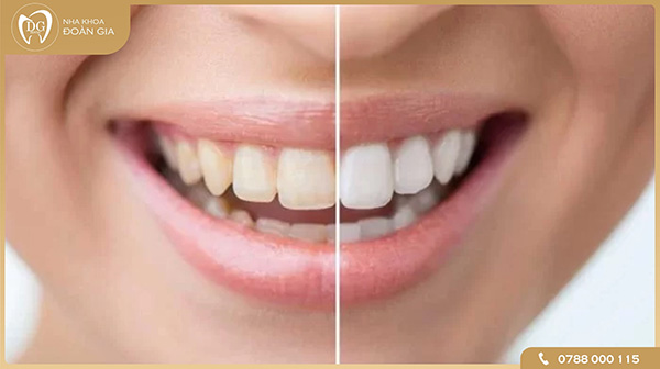 Tẩy trắng răng bằng đèn plasma có hại không ?