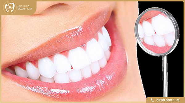 Tẩy trắng răng là gì? 