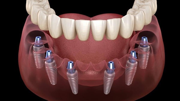 Trồng răng Implant All on 6 là gì?