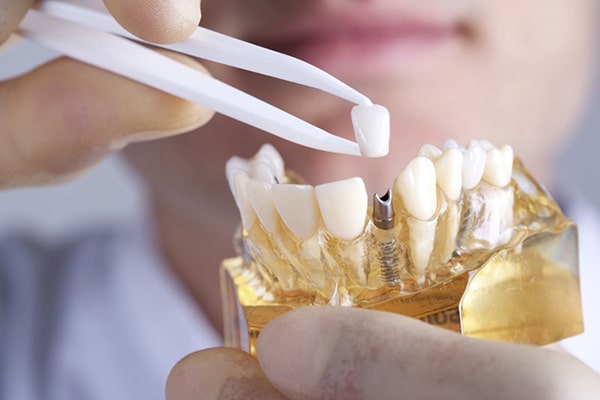Sau khi trồng răng Implant có đau không?