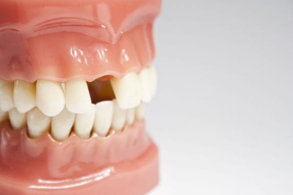 Ảnh hưởng tới cuộc sống do mất răng gây ra