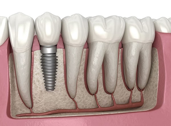 Trồng răng Implant là gì?
