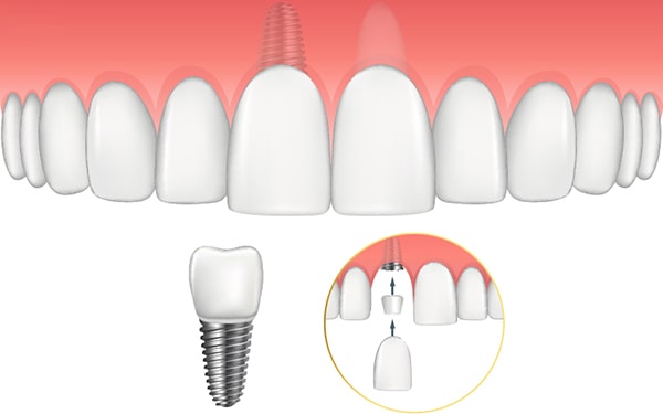 Làm răng Implant từng chiếc riêng lẻ