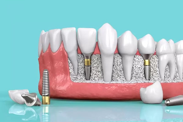 Trồng răng Implant dùng được bao lâu? Có bền không?