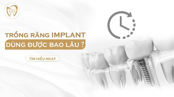 Thời gian trồng răng Implant dùng được bao lâu? 