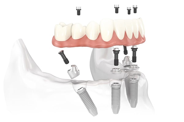 Trồng răng implant toàn hàm All on 4 và All on 6 là gì?