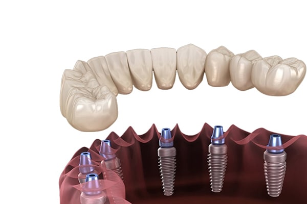 Ai nên trồng răng Implant toàn hàm All on 4, All on 6?
