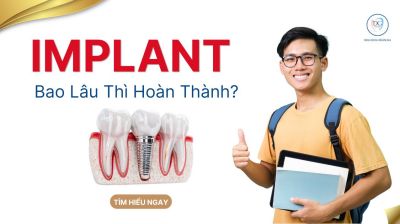TRỒNG IMPLANT BAO L&Acirc;U TH&Igrave; HO&Agrave;N TH&Agrave;NH