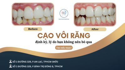 CẠO V&Ocirc;I RĂNG ĐỊNH KỲ 6 TH&Aacute;NG/LẦN &ndash; L&Yacute; DO BẠN KH&Ocirc;NG N&Ecirc;N BỎ QUA