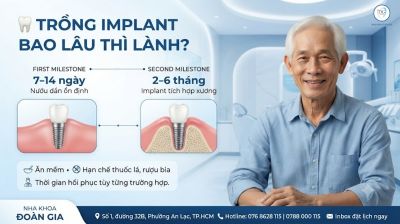Trồng Implant Bao L&acirc;u Th&igrave; L&agrave;nh? C&aacute;c Giai Đoạn Hồi Phục