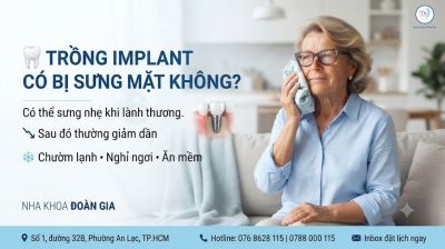 Trồng Implant C&oacute; Bị Sưng Mặt Kh&ocirc;ng? Bao L&acirc;u Hết Sưng?
