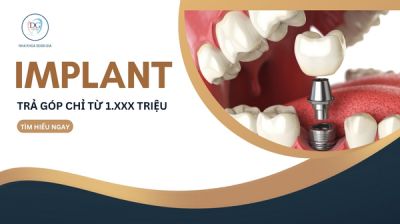 IMPLANT TRẢ GÓP CHỈ TỪ 1.XXX.000/THÁNG  RĂNG MỚI, TÚI TIỀN VẪN ÊM!